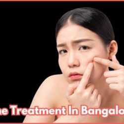 Acne Treatment In Bangalore - Charma Clinic